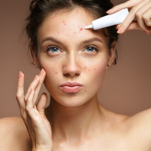 7 Causes of Adult Acne and Ways to Treat It