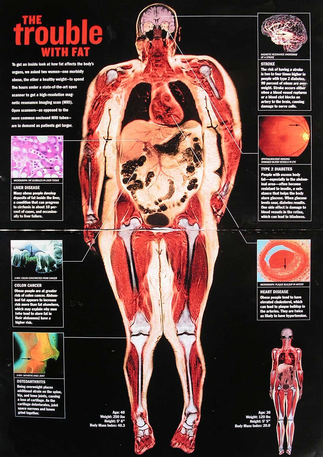 The Trouble With Fat