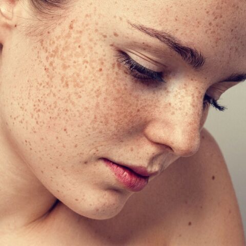 10 Best Ways to Get Rid of Freckles